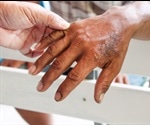 Leprosy Causes