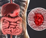 Peptic Ulcer History