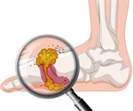 Gout and Diet