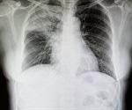 Pneumonia Epidemiology