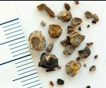 Ureteric Calculi Treatment Options