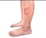 Ringworm in Babies