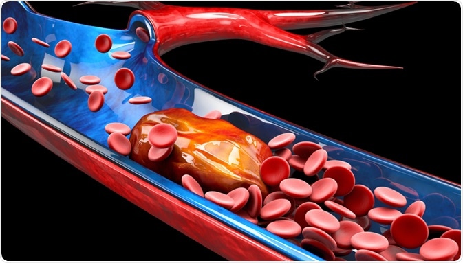 thrombosis