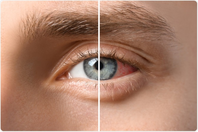 uveitis