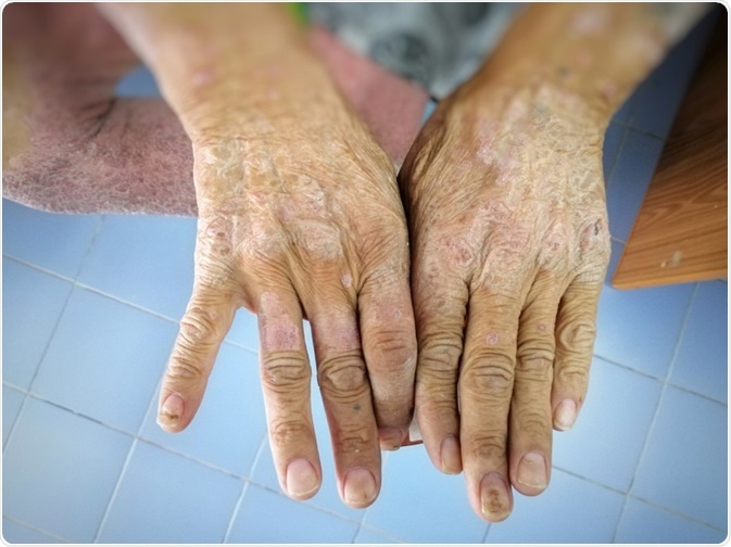 scleroderma