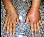 Lymphedema Symptoms