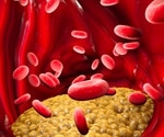 Hypertriglyceridemia Cause and Symptoms
