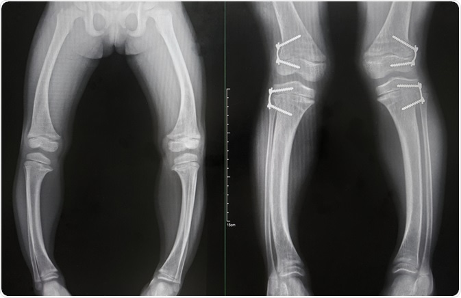 rickets