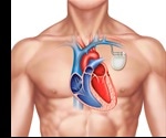 What is a Pacemaker?