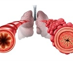What is Bronchiolitis?