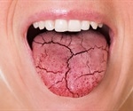 What is Xerostomia?
