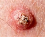 Keratoacanthoma Causes and Risk Factors