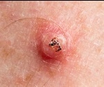 Keratoacanthoma Treatments and Management