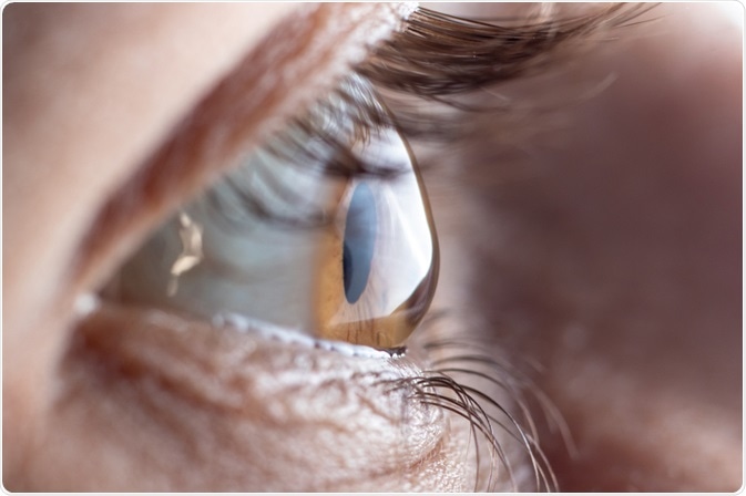 astigmatism