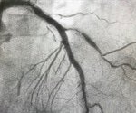 Restenosis Causes