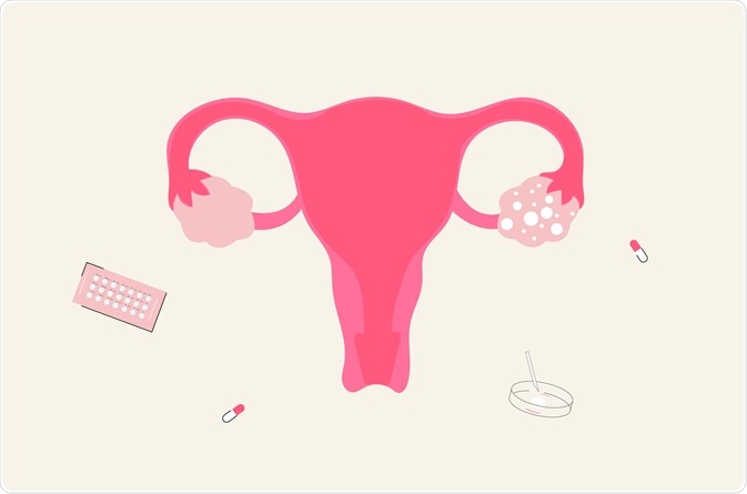 PCOS PCOS