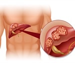 Secondary Liver Cancer