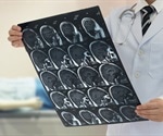 Stroke Prognosis