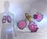 Idiopathic Pulmonary Fibrosis Diagnosis