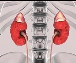 Farxiga approved in the US for the treatment of chronic kidney disease in patients at risk of progression with and without type-2 diabetes
