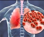Pneumonia Treatment