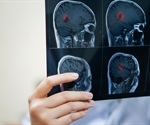 Glioma Treatment