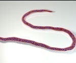 What is Onchocerciasis?