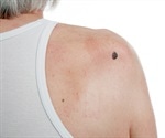 Squamous Cell Carcinoma Diagnosis