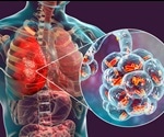 Pneumonia Classification