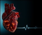 Recurring Pericarditis