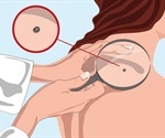 Squamous Cell Carcinoma Cause