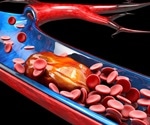 A study reports the first case of an upper extremity deep vein thrombosis (DVT) recurrence due to COVID-19 infection