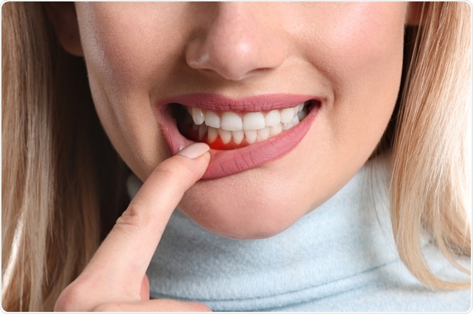 gingivitis