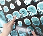 Cognitive Impairment and Multiple Sclerosis