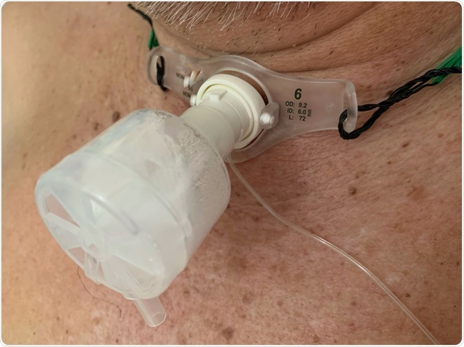 tracheotomy
