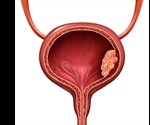Non-Invasive Diagnostic Strategies for Bladder Cancer