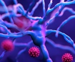 Study identifies most persistent neurological problems during long COVID-19