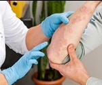 Psoriasis Clinical Classification