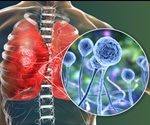 Mucormycosis Treatment