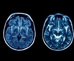 What is Joubert Syndrome?
