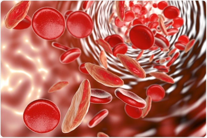 Sickle Cell Anemia Sickle Cell Anemia