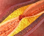 What is Carotid Artery Stenosis?