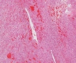 Angiosarcoma Treatments