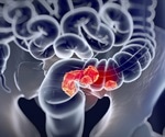 Should colorectal cancer screening start at age 45?