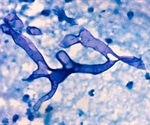 What is Mucormycosis?