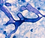 Black fungus complicates India's COVID pandemic