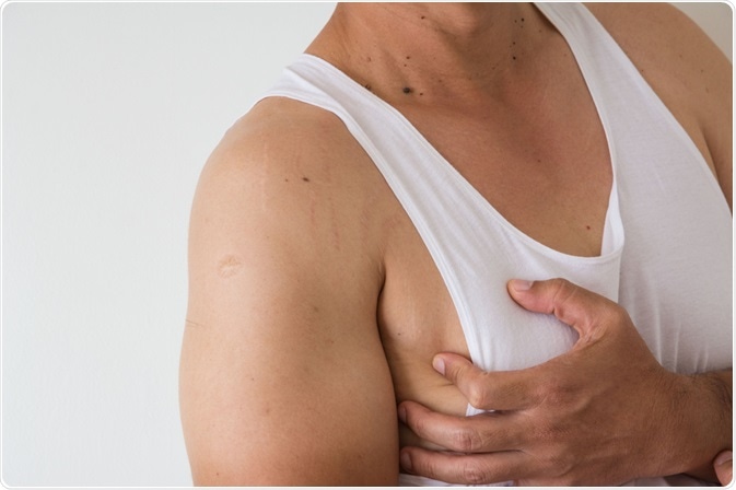 gynecomastia