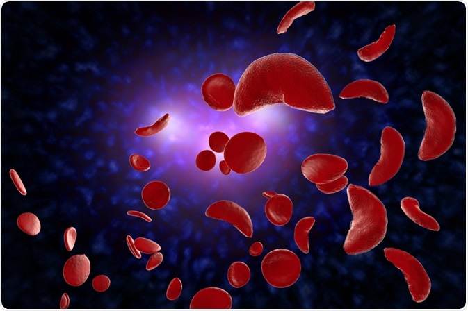 Sickle Cell Disease Sickle Cell Disease
