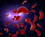 Treatment Options for Sickle Cell Disease