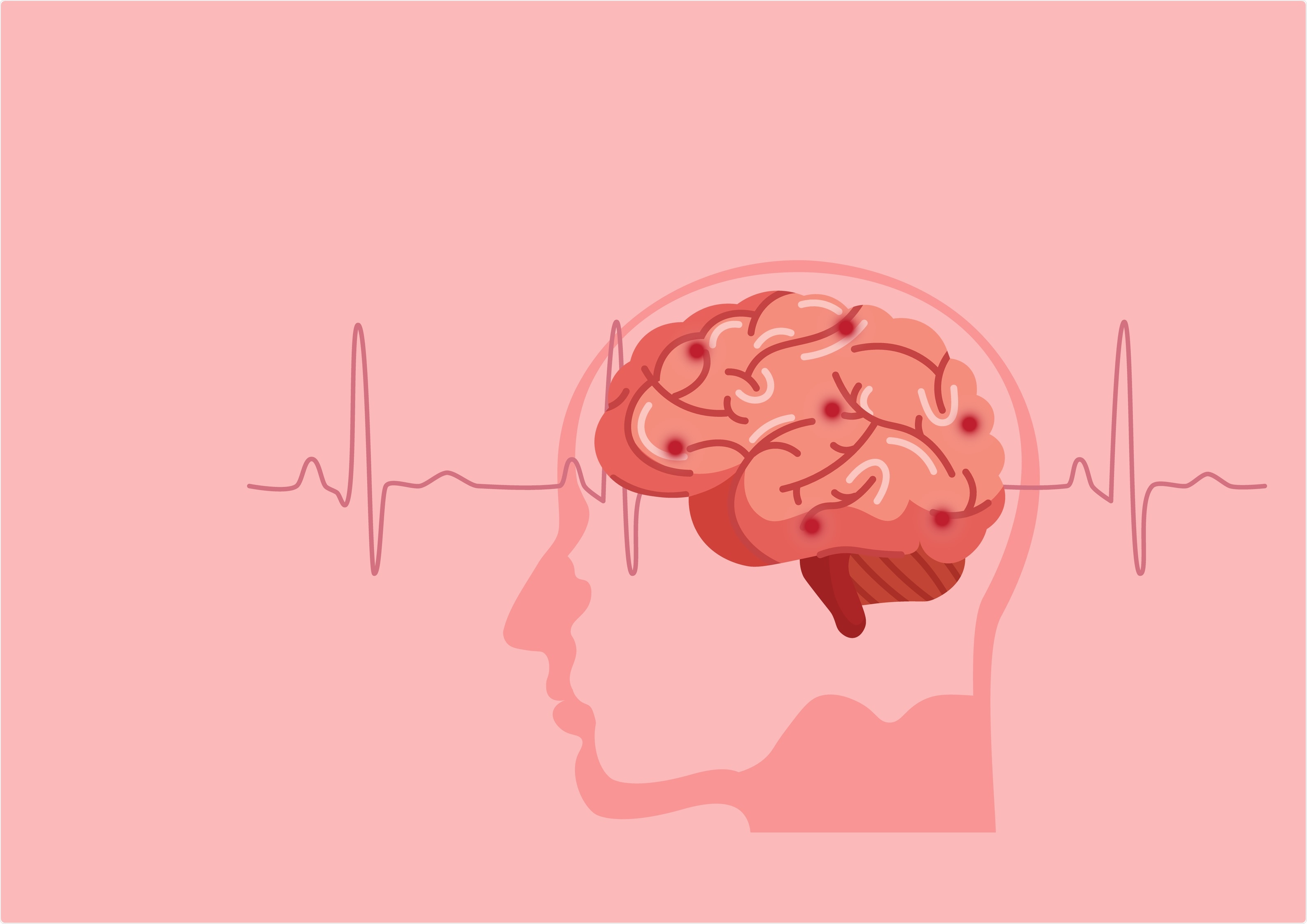 Stroke